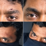 సినిమాను మించి.. కనుబొమ్మపై గాయం గుర్తుతో దొంగ గుట్టు రట్టు