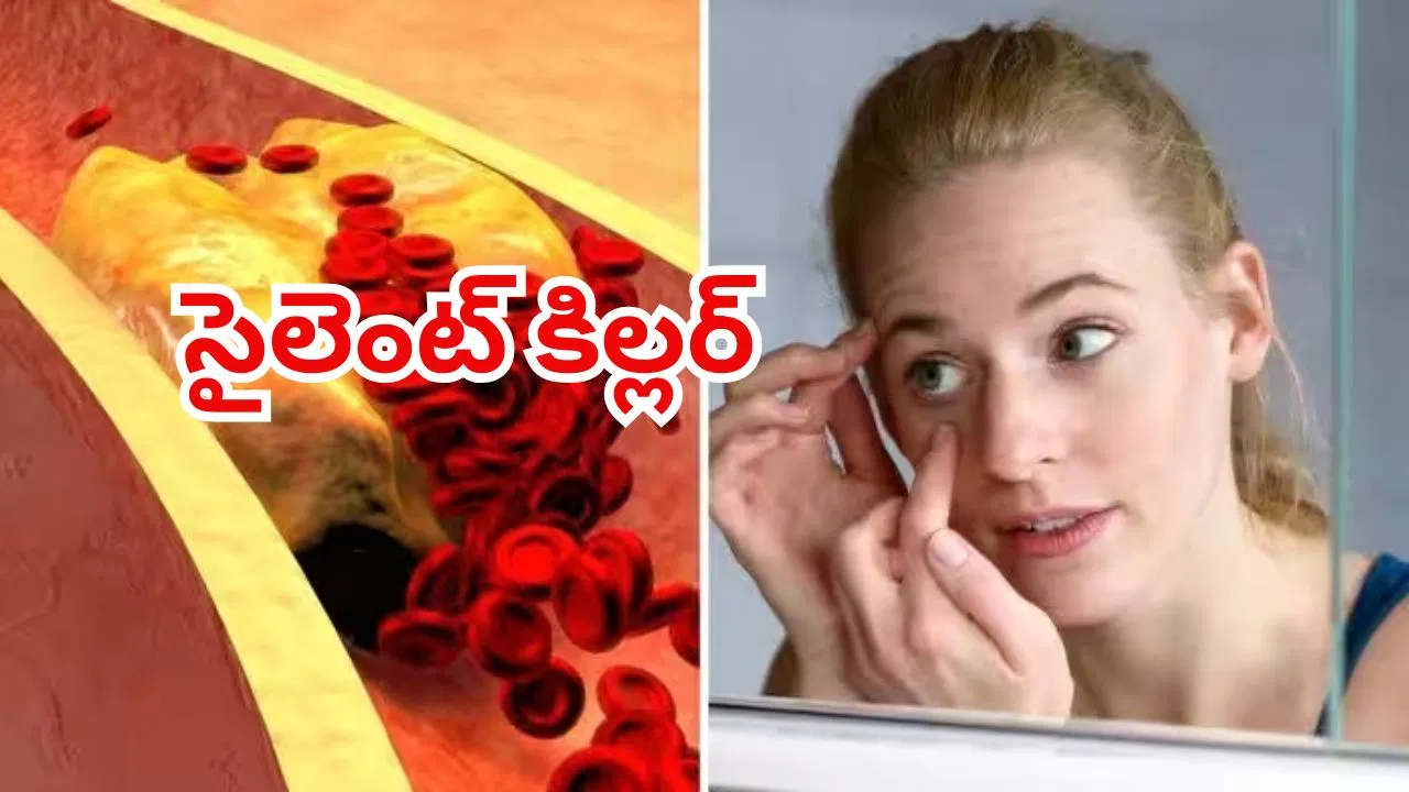 High cholesterol warning signs appearing in eyes, skin and legs.