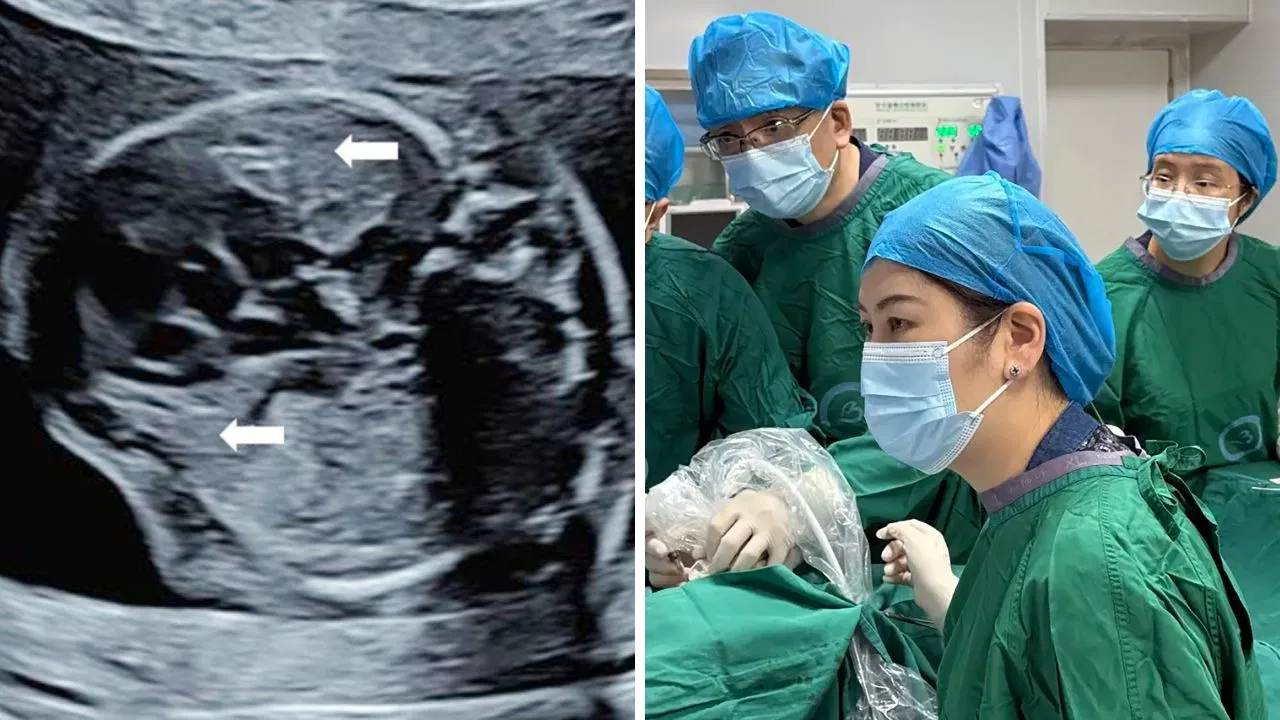 Doctors performing ultrasound-guided fetal tumor treatment in China.